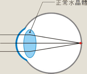 正常眼