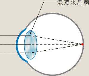 白內障眼