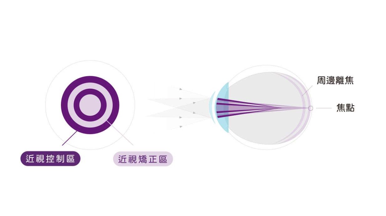 學童近視控制日拋隱形眼鏡