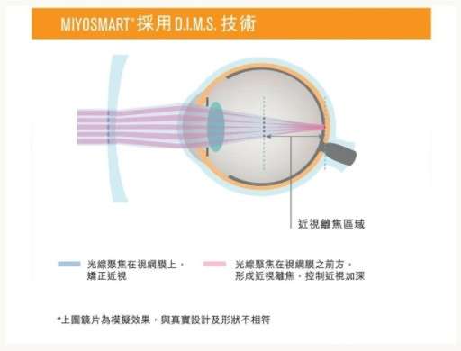 兒童近視控制鏡片原理