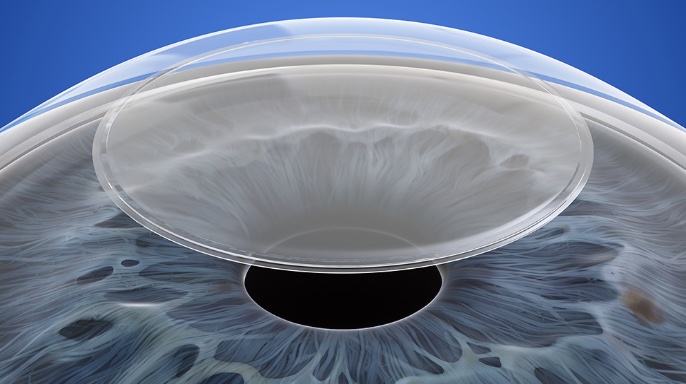 Silk極飛秒近視雷射